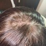 Scalp Micro Pigmentation(Front Edges)