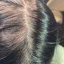 Scalp Micro Pigmentation(Front Edges)