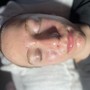 60 Minute Acne Facial And High Frequency treatment