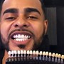 Full set 20 veneers