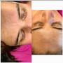 Microdermabrasion