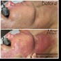 ADD-ON ONLY! Dermaplaning