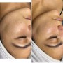 Microdermabrasion Facial