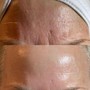 Chemical Peel Facial