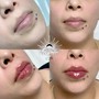 Lip Sugaring