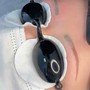 Laser Tattoo Removal On Small Area 5cmx10cm