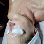 Microdermabrasion