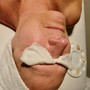 Microdermabrasion