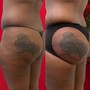 Non-invasive Buttock enhancement