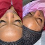 Dermaplane Facial