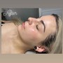 Acne Facial