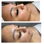 Chemical peel