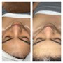 Microdermabrasion