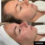 Dermaplaning