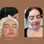 High frequency Acne Facial