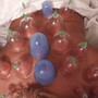 Cupping Massage