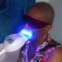 Microdermabrasion with LED