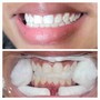 Teeth Whitening