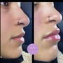 No-Surgery Nose Job