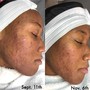 Microdermabrasion