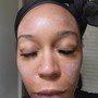 Chemical Peel