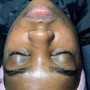 Acne Facial