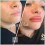 1ML Lip Filler