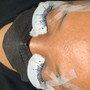 Acne Facial