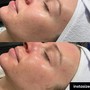 Dermaplaning