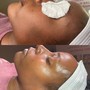 Chemical peel