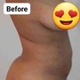 Single Session Back Slimming/Sculpting Treatment