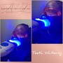 30 Minute Teeth Whitening