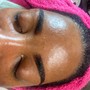 Microdermabrasion