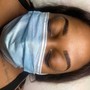 Microdermabrasion