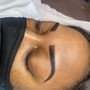 Microdermabrasion