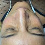 Dermaplaning Facial