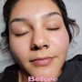 Microdermabrasion facial