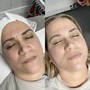 RF Skin Tightening