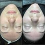 Microdermabrasion w/ facial