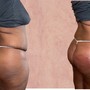 Non-invasive Buttock enhancement