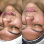 Hydra Facial