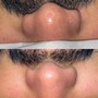 Hydra Facial