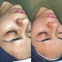 Chemical Peel