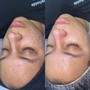 Chemical Peel