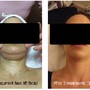 Dermatude MetaTherapy Face and Neck