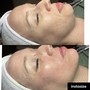 Dermaplaning