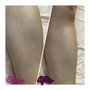 Leg Sugaring