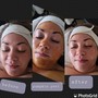 3 part Facial Series with 2  Modalities