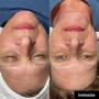 HydraFacial- Back Facial