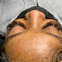 Facial treatment/ microdermabrasion